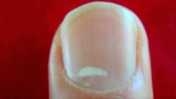 Белые пятна на ногтях пальцев рук: причины появления и лечение