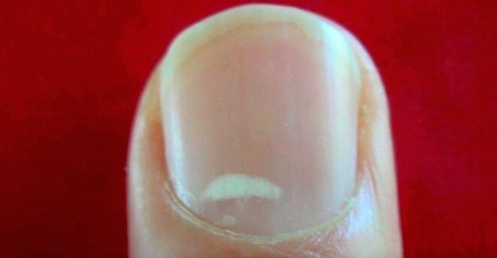 כתמים לבנים על ציפורני האצבעות: סיבות וטיפול