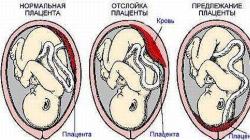 Regional placenta previa: תסמינים, טיפול